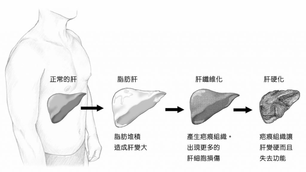 脂肪肝-肝硬化過程