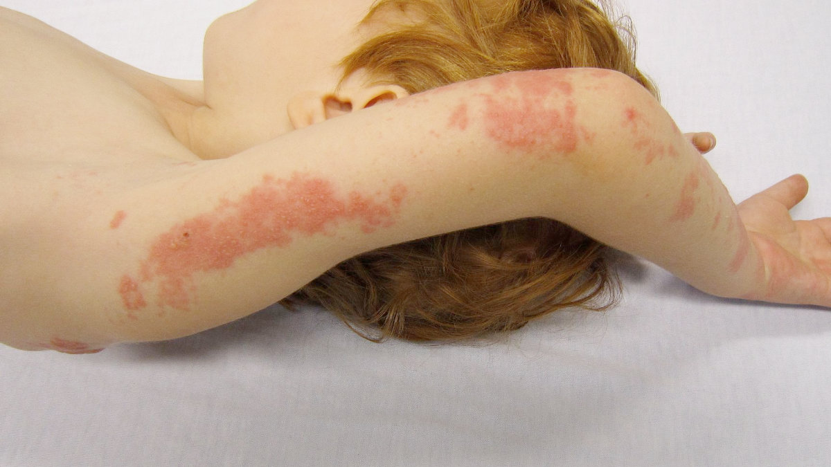 帶狀皰疹-皮蛇 帶狀皰疹-皮蛇